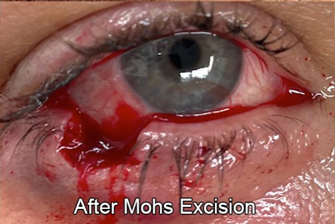 Eyelid Reconstruction After Skin Cancer After Mohs Excision
