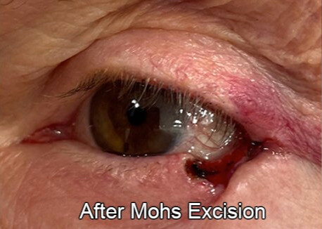 Eyelid Reconstruction After Skin Cancer After Excision