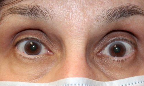 Orbital Tumor Located Underneath the Eye After