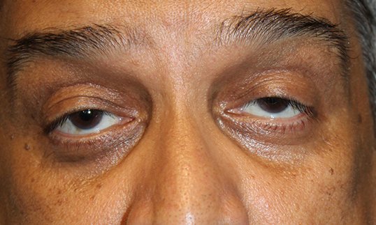 Ptosis Procedure Before
