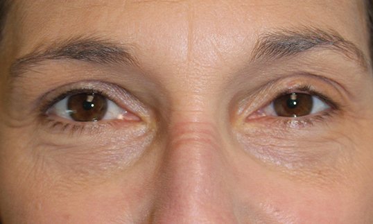 Ptosis Procedure Before
