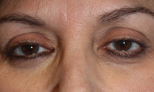 Ptosis Procedure Before