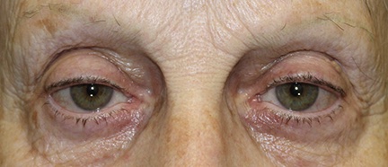 Ptosis repair on upper eyelids. Before