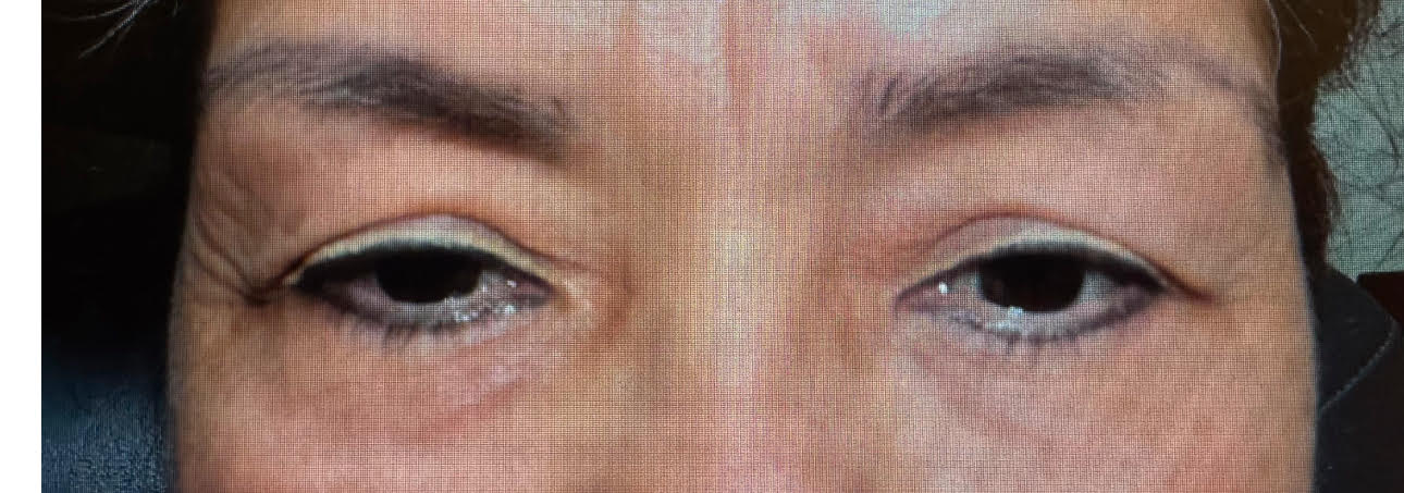 Ptosis Repair and Browpexy Before