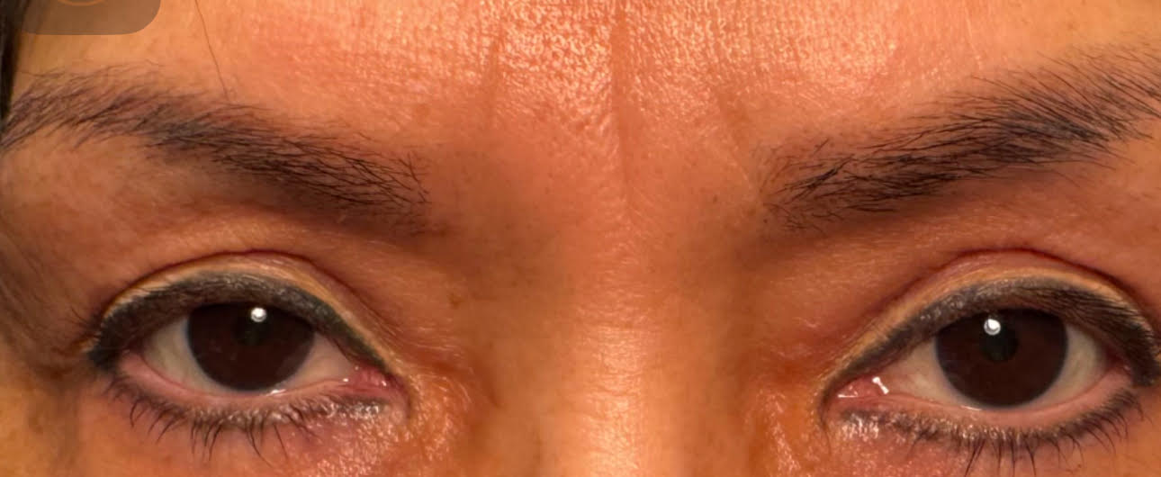 Ptosis Repair and Browpexy After