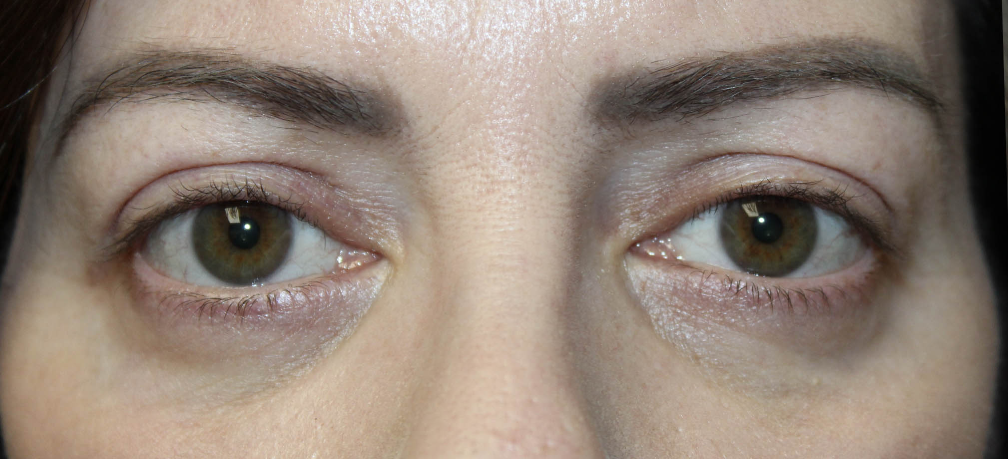 Upper & Lower Blepharoplasty with TCA peel After
