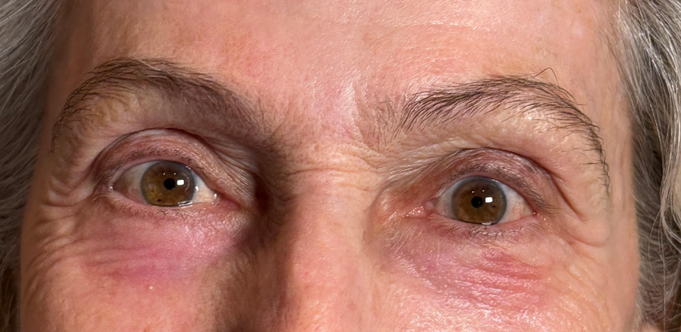 Ptosis Repair Both Upper Lids After