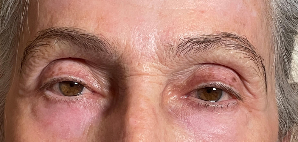 Ptosis Repair Both Upper Lids Before