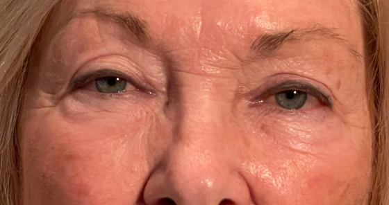 Ptosis Repair Both Upper Lids Cosmetic Blepharoplasty Both Upper lids Before