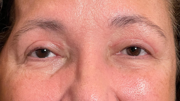 Ptosis Repair Both Upper Lids Cosmetic Blepharoplasty Both Upper lids Before