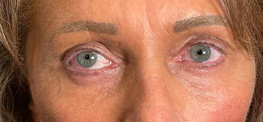 Ptosis Repair Upper Lids MMCR Procedure After