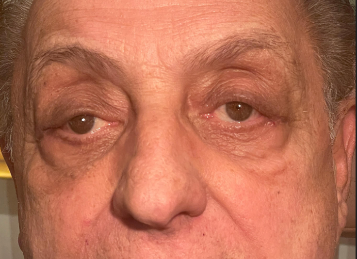 Ptosis Repair Both Upper Eyelids & Ectropion Repair Both Lower Lids Before