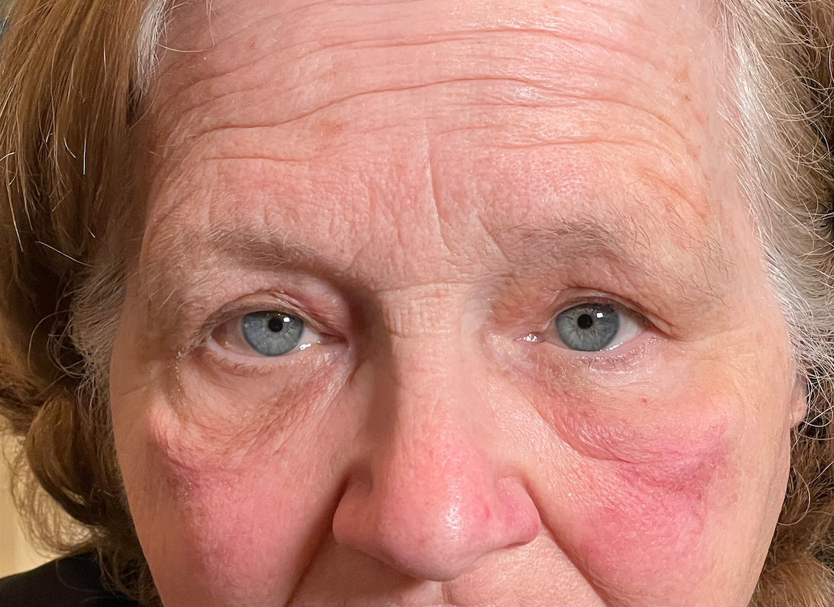 Upper Lid Ptosis Repair and Cosmetic Blepharoplasty After