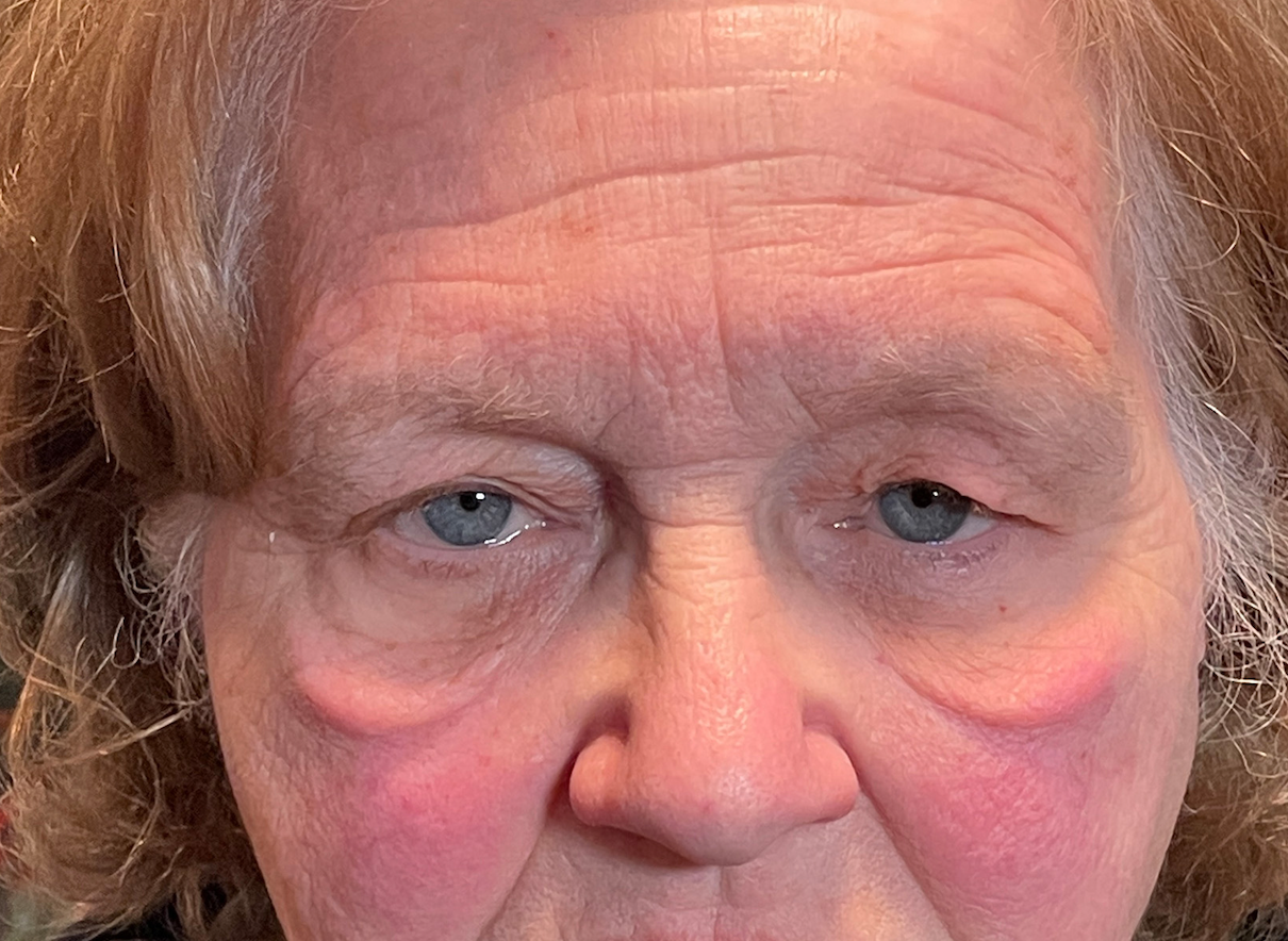 Upper Lid Ptosis Repair and Cosmetic Blepharoplasty Before