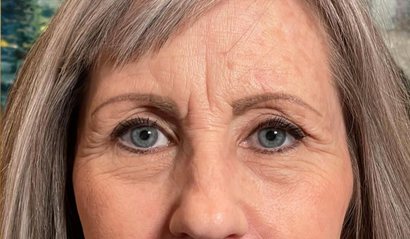 Ptosis Repair After