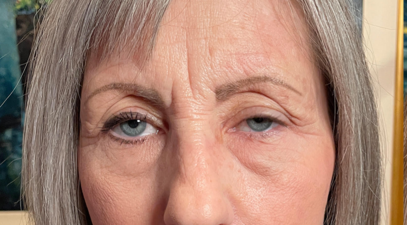 Ptosis Repair Before