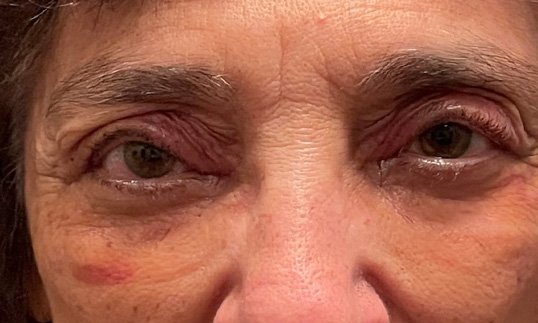 Ptosis Repair After