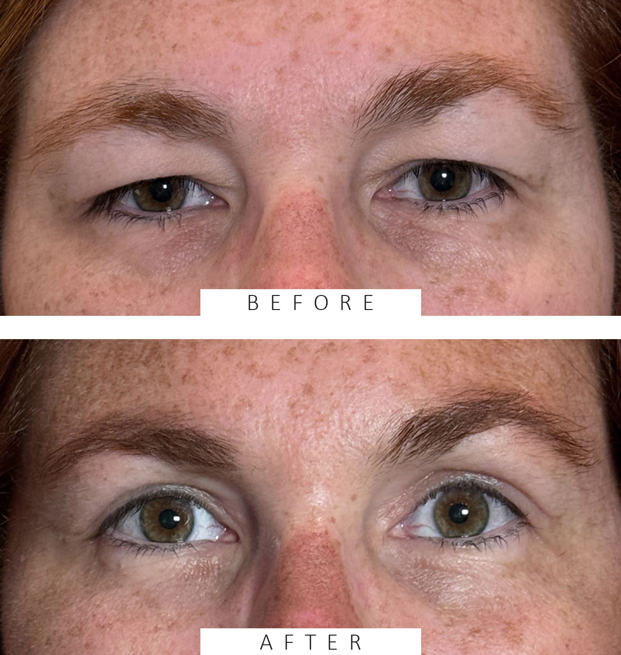 MMCR Ptosis Repair Both Upper Lids Cosmetic Blepharoplasty Both Upper Lids