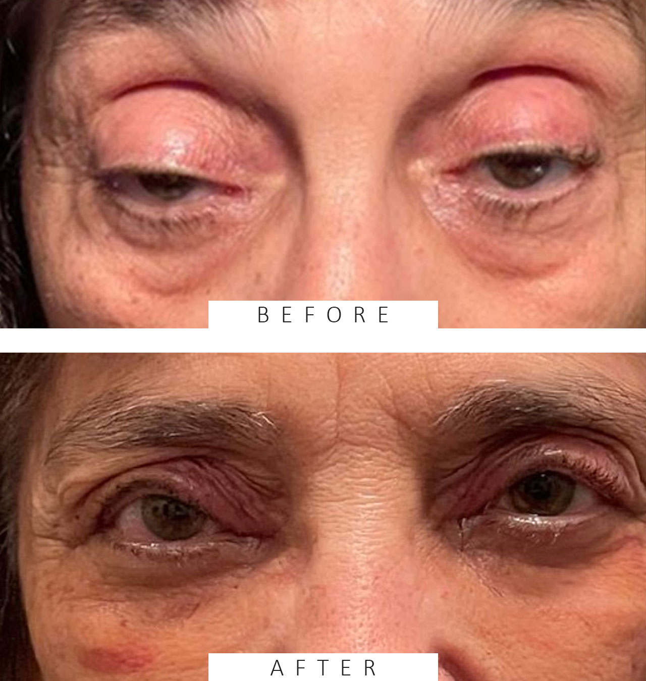 Ptosis Repair