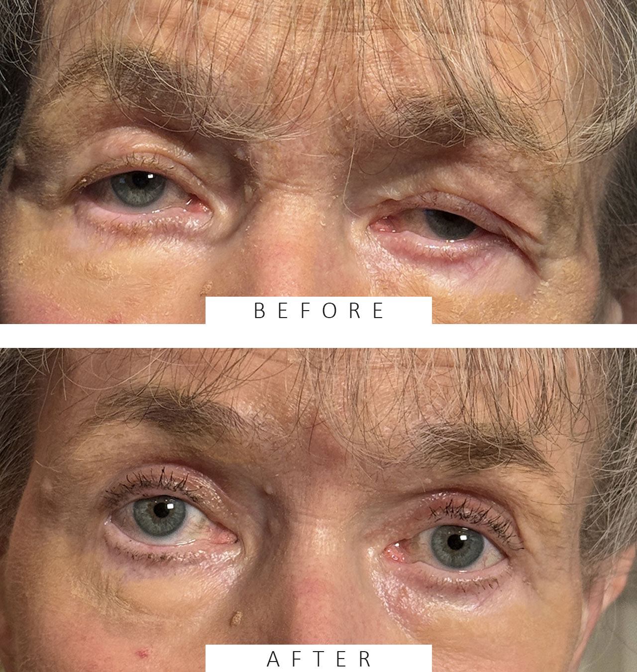 Cosmetic Blepharoplasty BULs