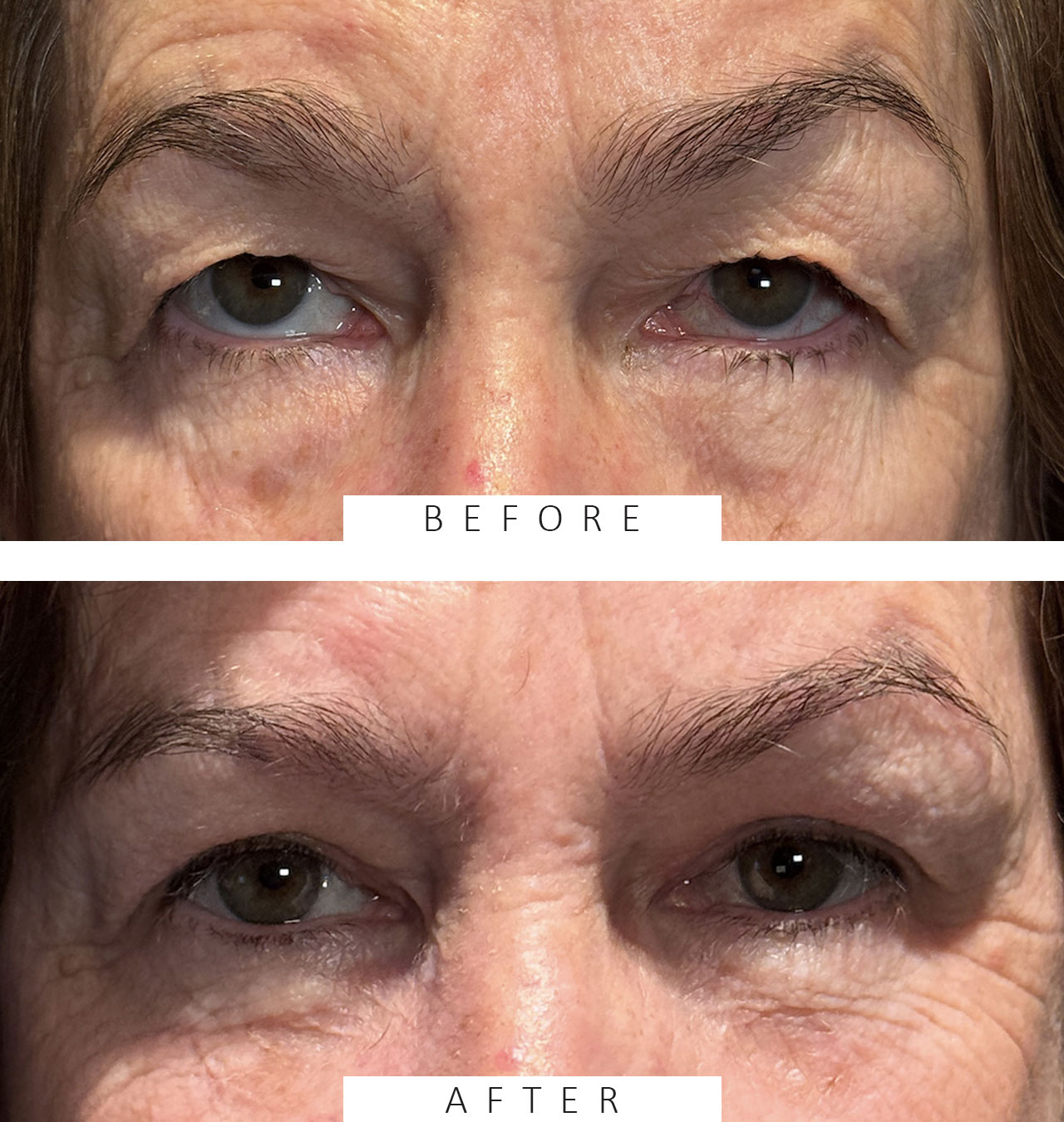 Cosmetic Blepharoplasty BULs