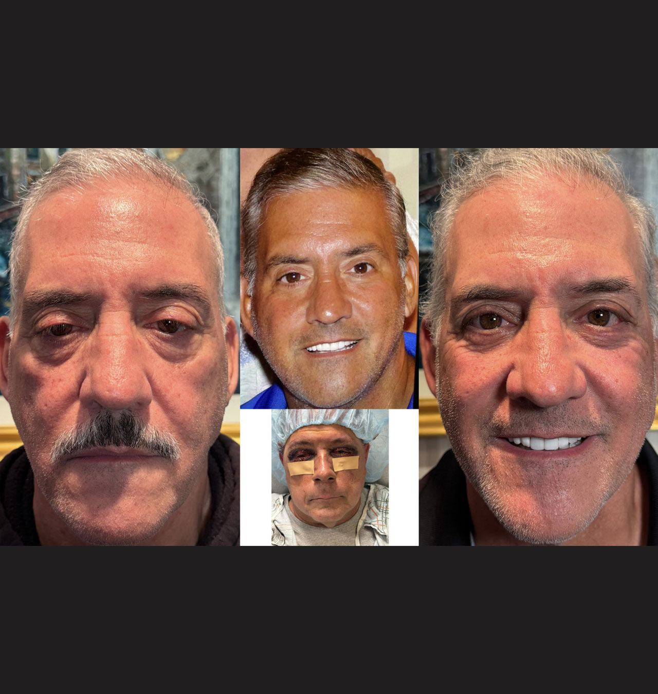 Ptosis Repair Both Upper Eyelids & Lower Eyelid Blepharoplasty with Fat Transposition