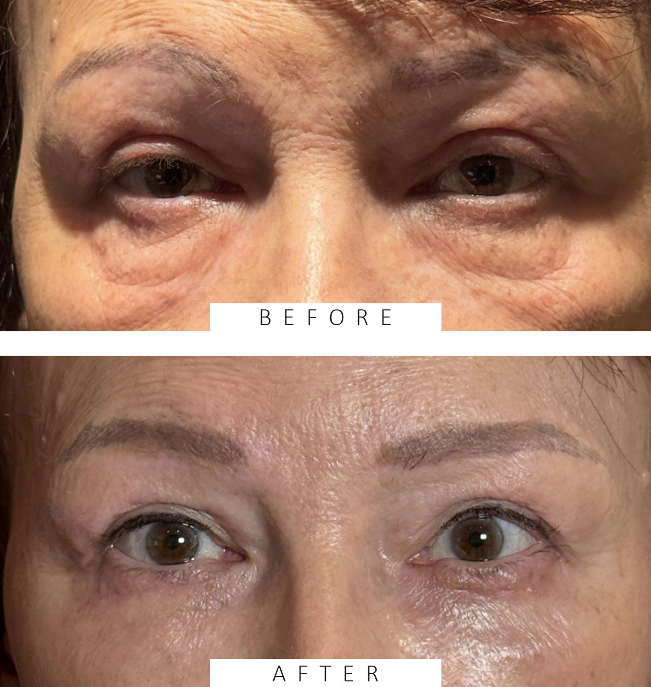 Blepharoplasty Both Upper and Both Lower Lids Full face Fractional CO2 Laser