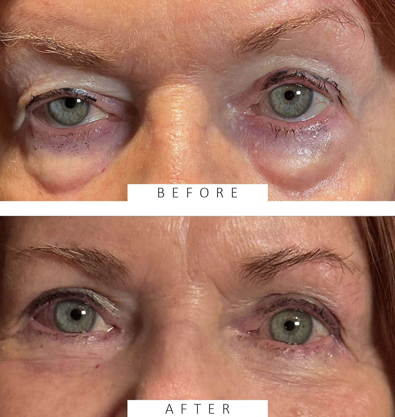 Upper and Lower Eyelid Blepharoplasty.