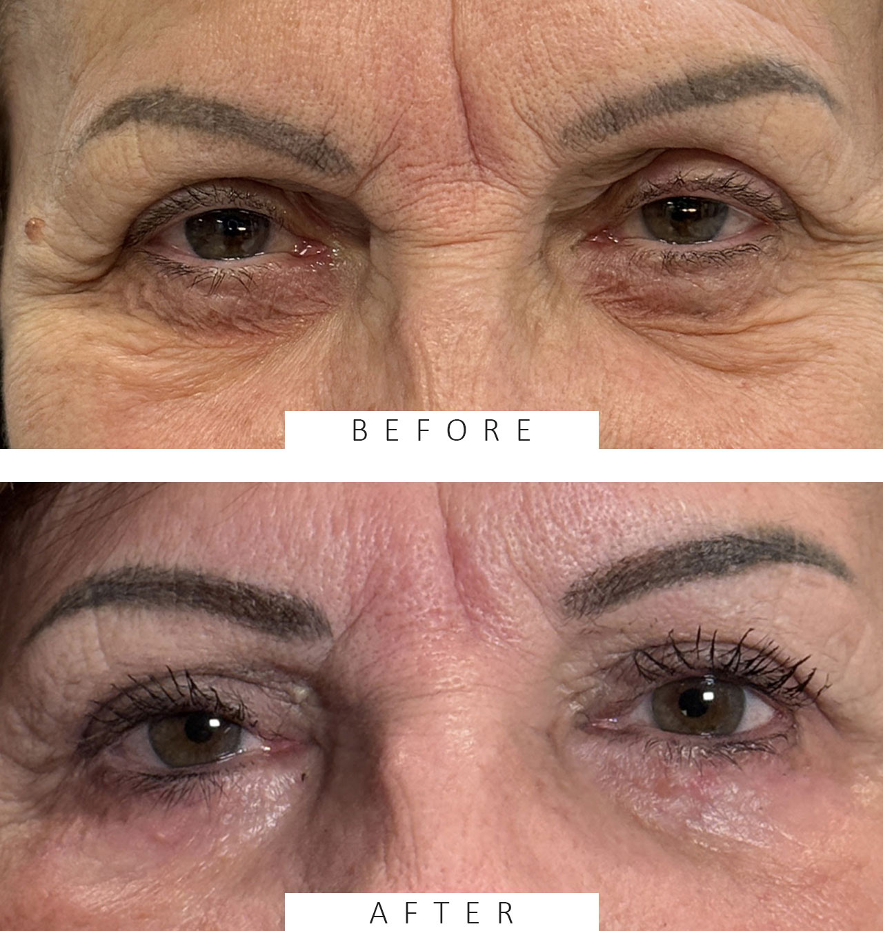 Upper and Lower Eyelid Blepharoplasty.