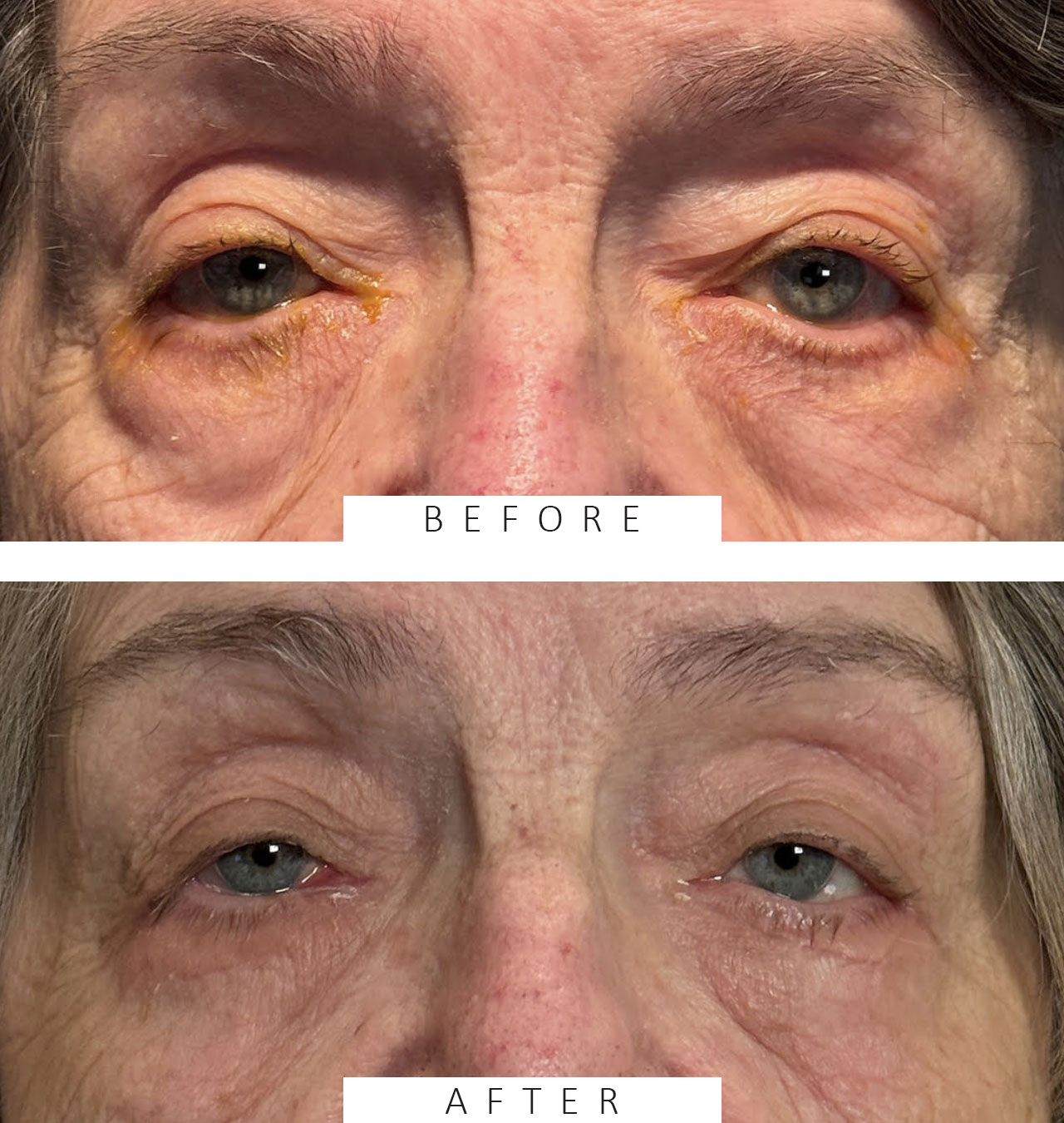 Lower Eyelid Belpharoplasty, Lower Eye Lid Fat Transposition and Fat Reduction, Effacement of Lower Lid Hollows and Lateral Canthal Slings Skin pinch blepharoplasty reduction of loose skin of lower eyelids.