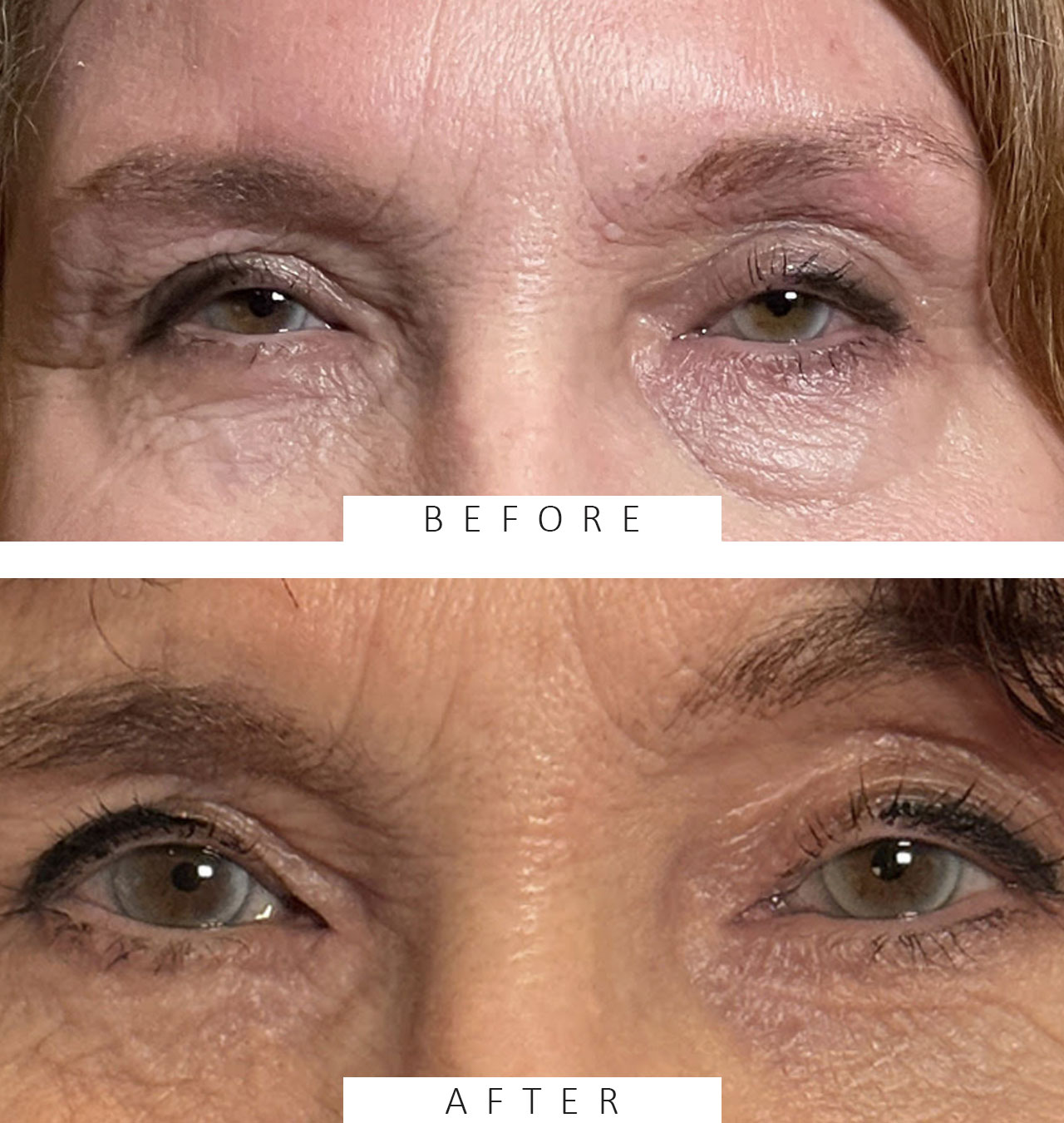 Lower Lid Blepharoplasty with Fat Transposition to Efface Hollows and Reduce Fat Bags