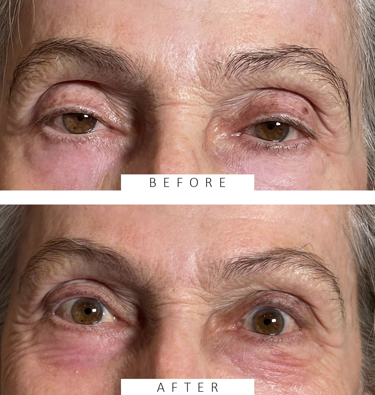 Ptosis Repair Both Upper Lids