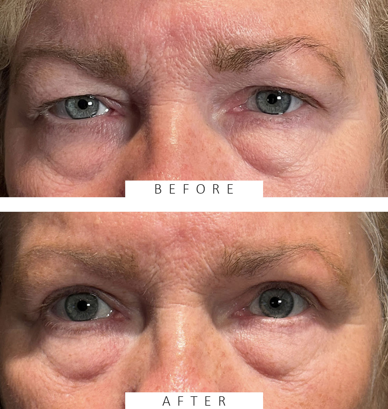 Cosmetic Blepharoplasty BULs & Ptosis Repair BULs