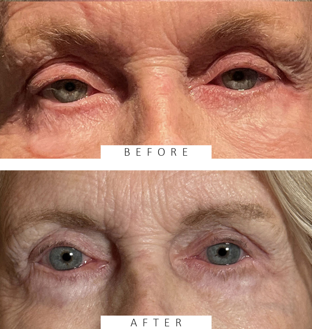 Upper Lid Blepharoplasty with Fat Transposition to mitigate Hollows/A-frame deformity Both Upper Lid Ptosis Repair MMCR Lower Lid Blepharoplasty with Skin Pinch Blepharoplasty Lateral Canthal Suspension