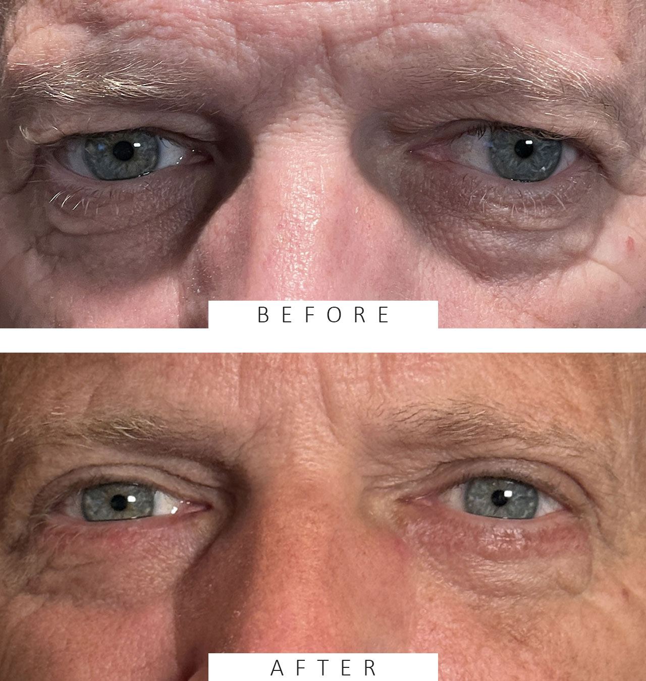 Cosmetic Blepharoplasty Both Upper and Lower Eyelids
