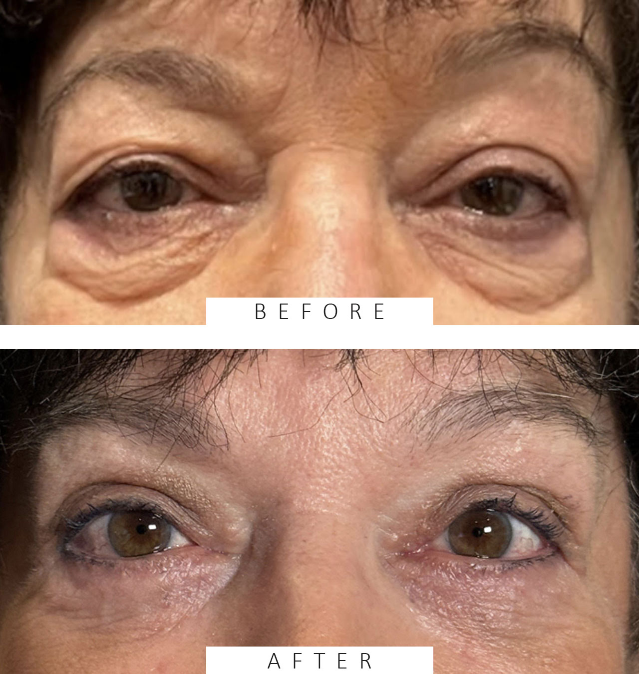 Upper and Lower Lid Blepharoplasty Fat Transposition to Efface Lid/Cheek Hollows Skin Pinch to remove Excess Skin Lower lids.