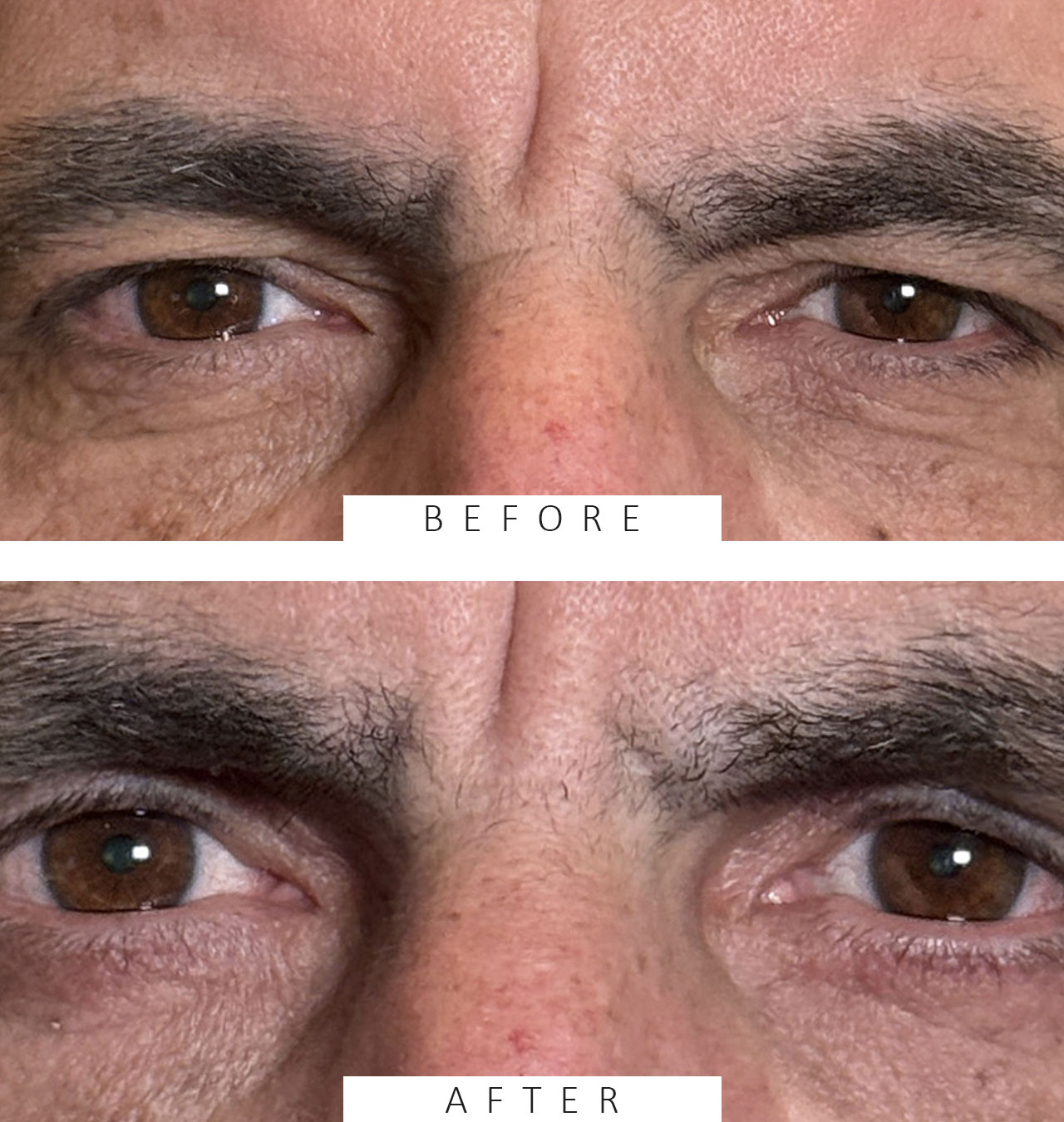 Blepharoplasty Both Upper and Lower Lids