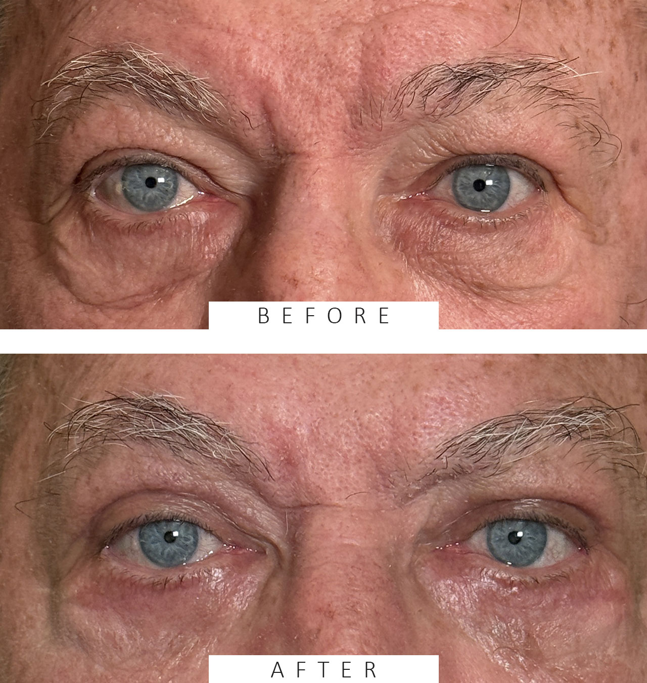 Upper and Lower Lid Cosmetic Blepharoplasty