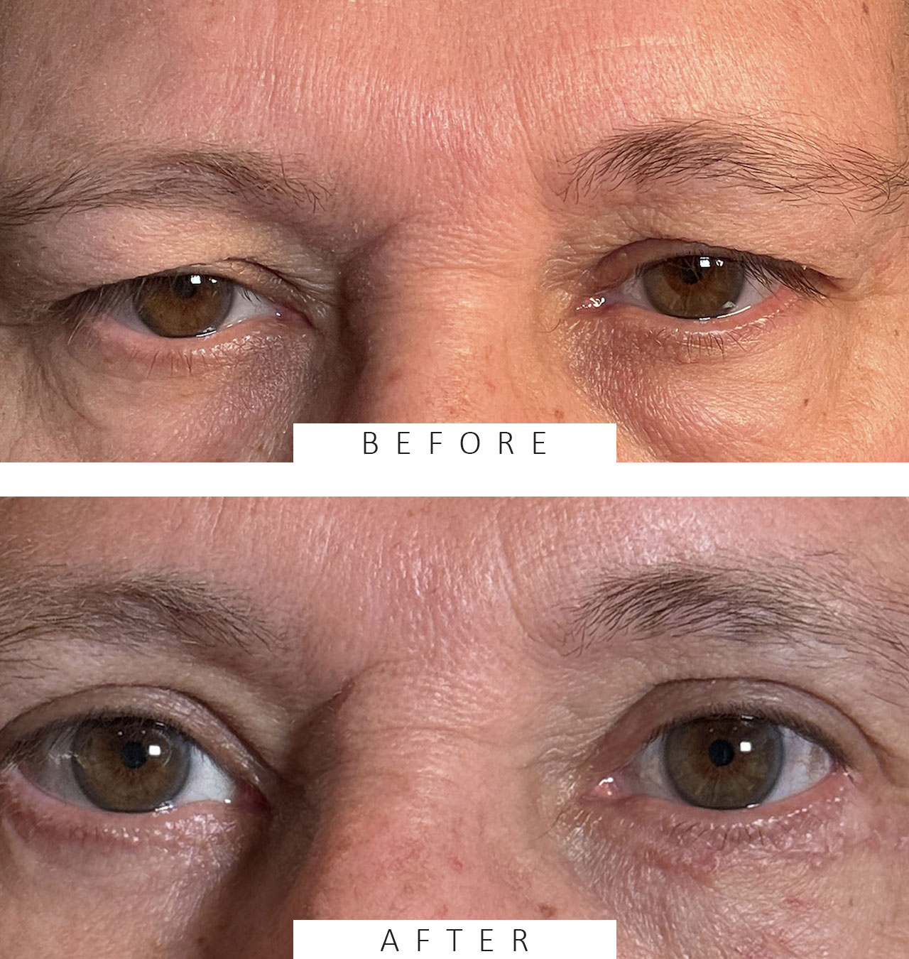 Upper Lid Blepharoplasty with Fat Transposition Lower Lid Blepharoplasty with Fat Subtraction & Transposition