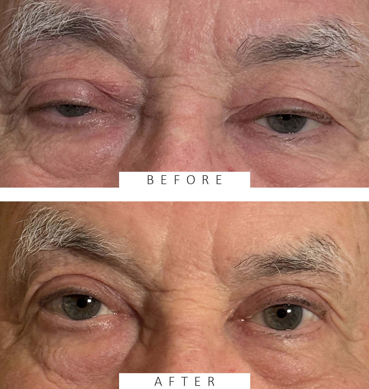 Cosmetic Blepharoplasty Upper Lids MMCR Ptosis Repair Both Upper Lids