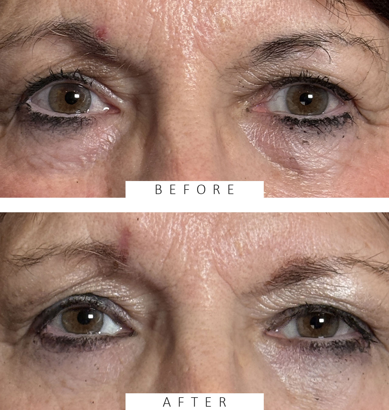 Lower Lid Blepharoplasty Both Lower Lids Fat Subtraction and Lower Lid Fat Bags Removal