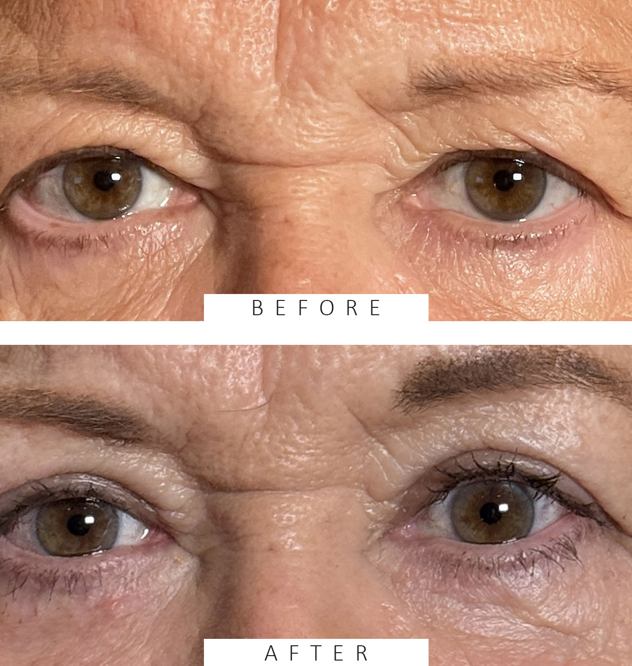 Cosmetic Blepharoplasty Upper and Lower Lids
