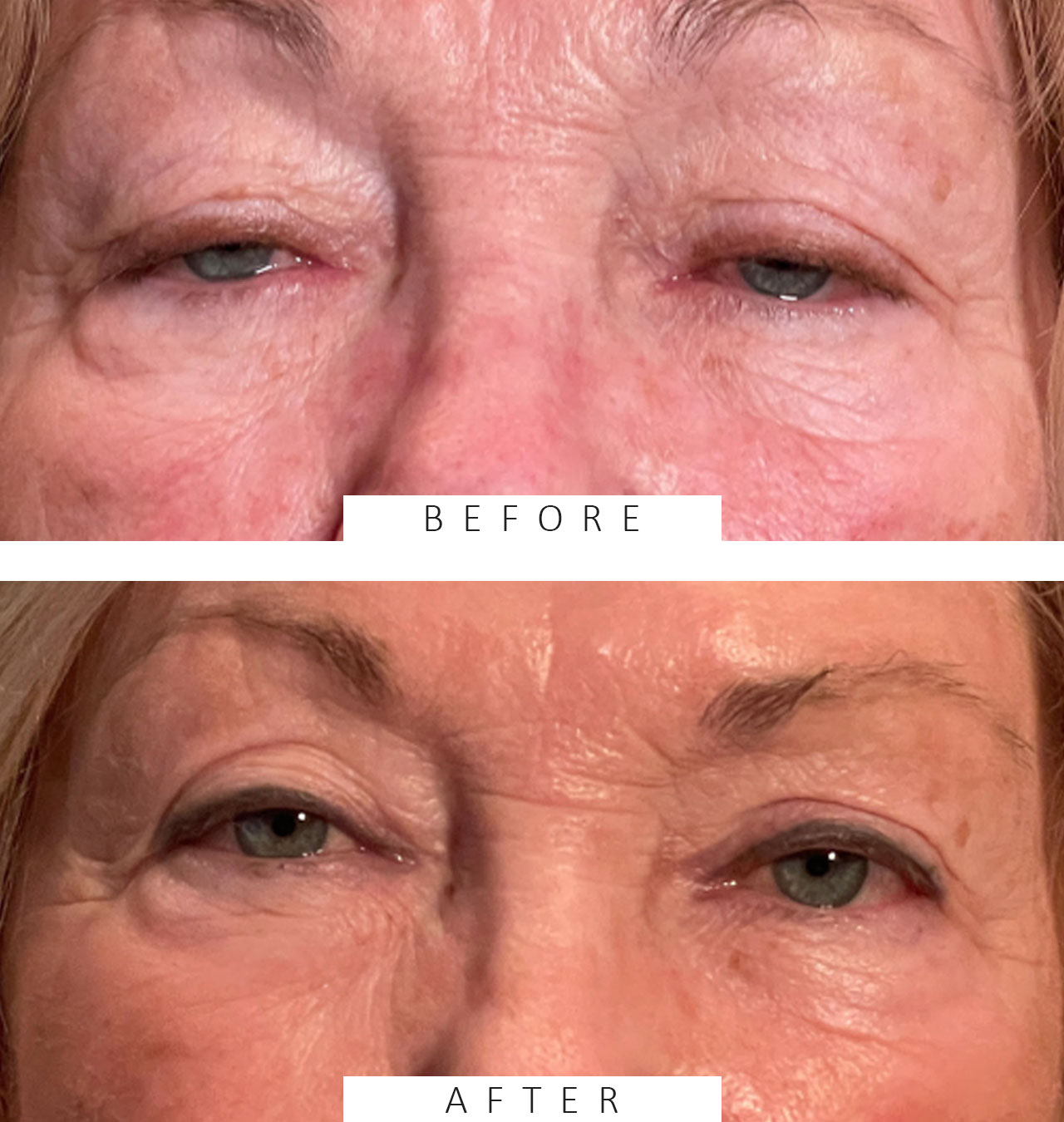 Ptosis Repair Both Upper Lids Cosmetic Blepharoplasty Both Upper lids