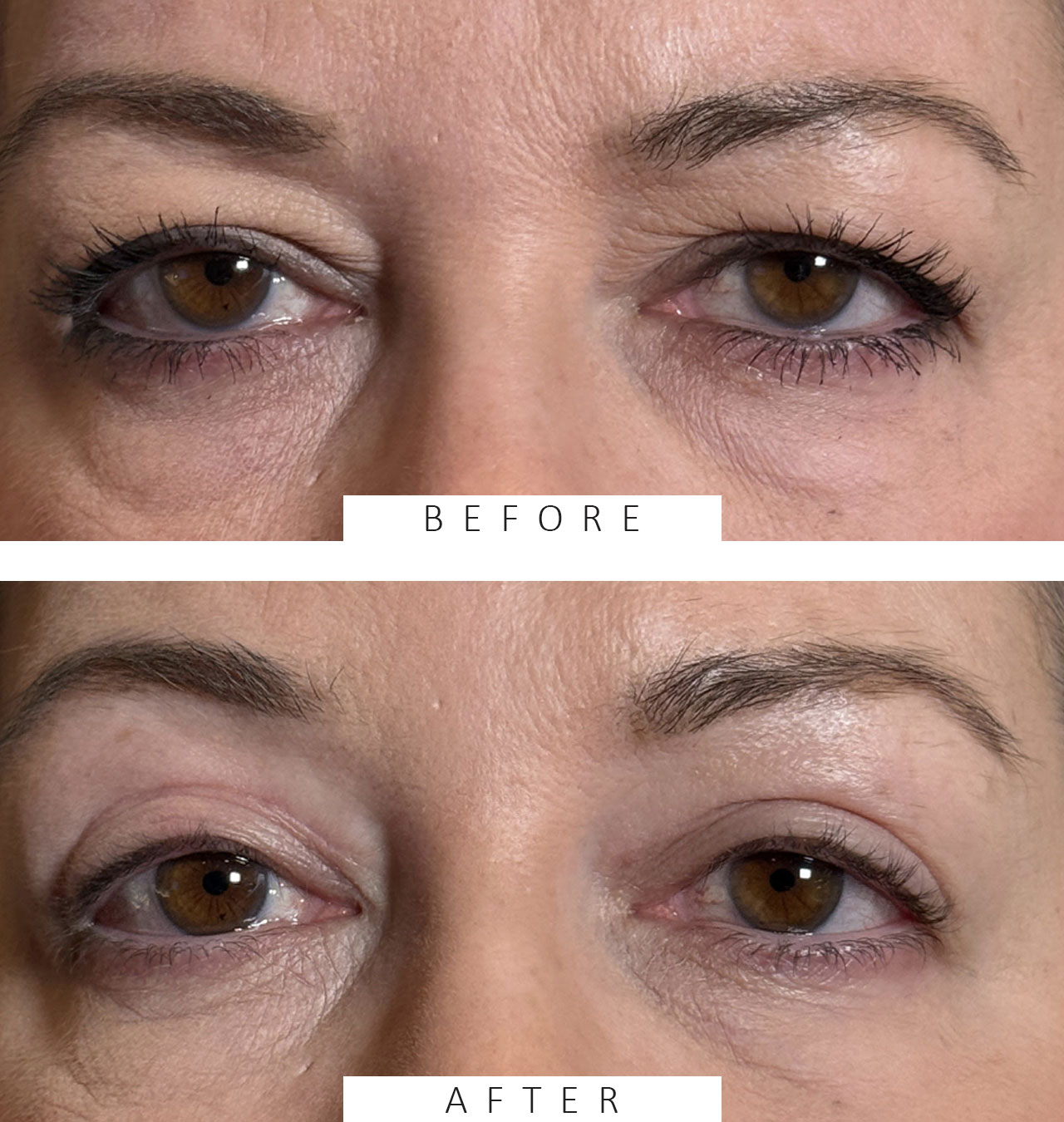 Cosmetic Blepharoplasty BULs
