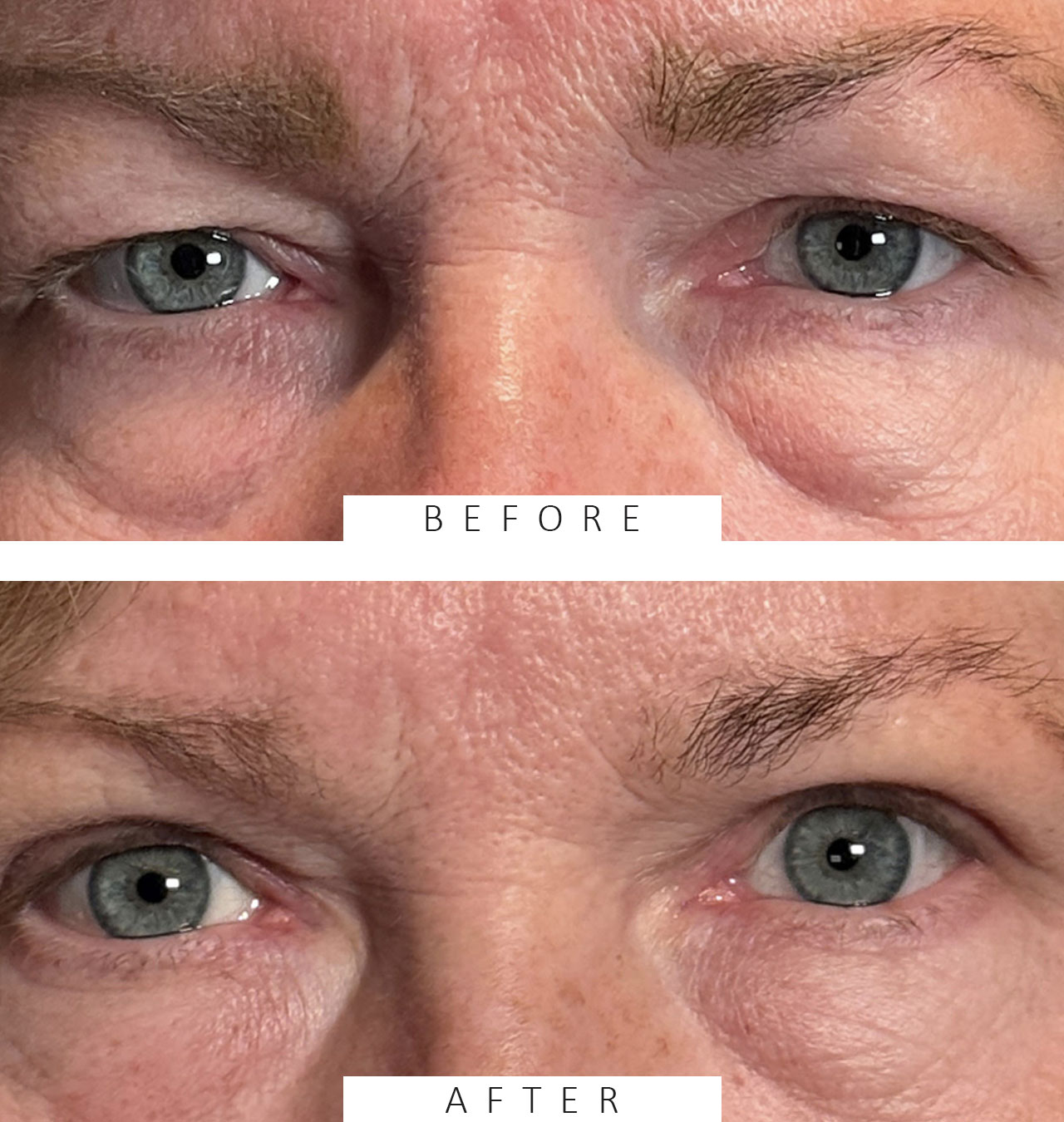 Cosmetic Blepharoplasty BULs