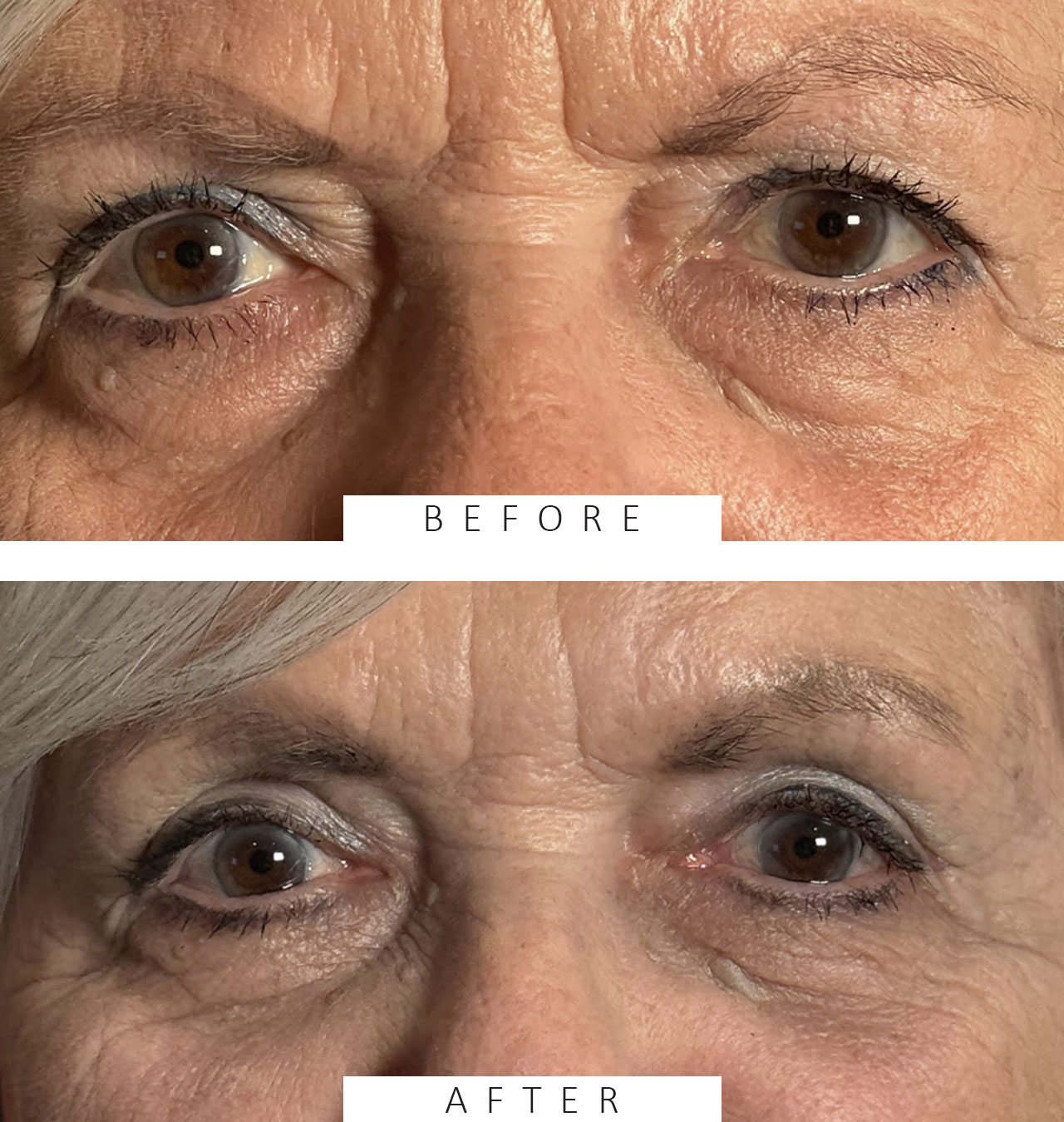 Cosmetic Blepharoplasty BULs