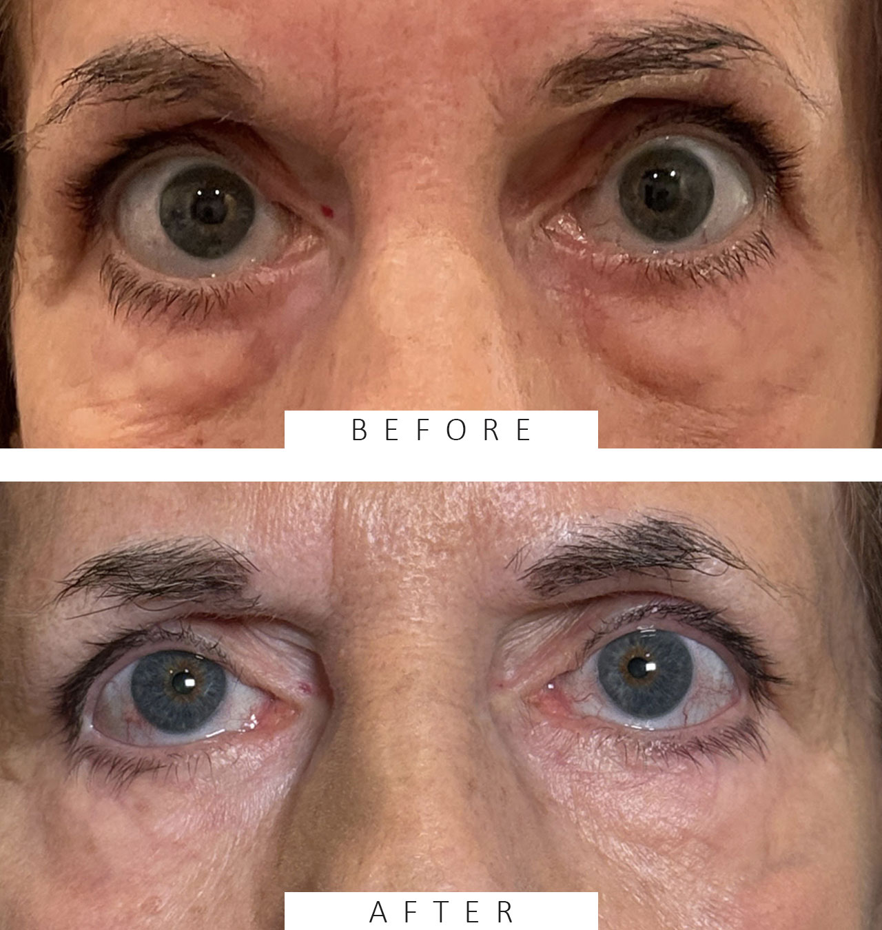 Blepharoplasty Both Lower Lids
