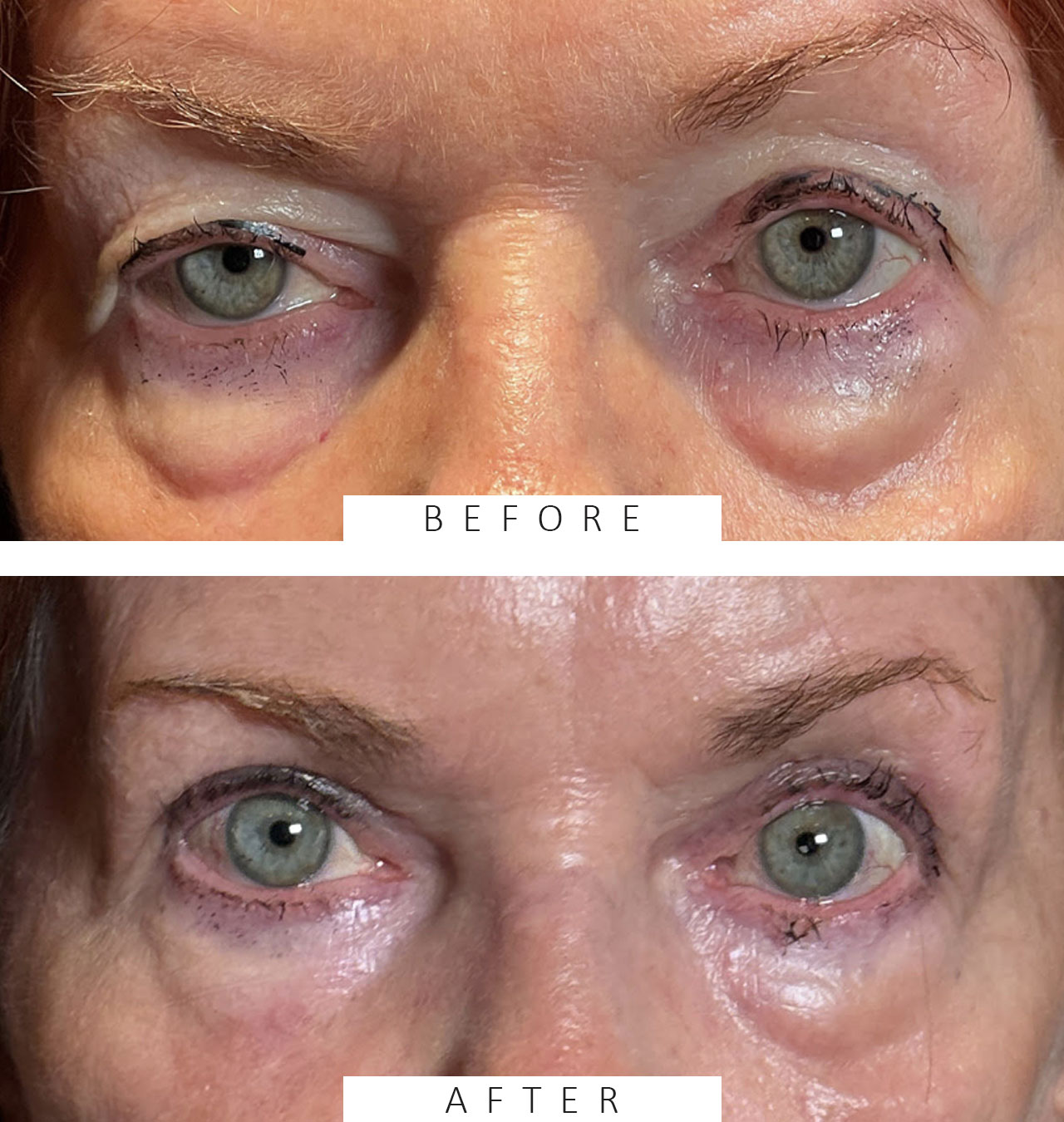 Ptosis Repair and Cosmetic Blepharoplasty Both Upper Lids