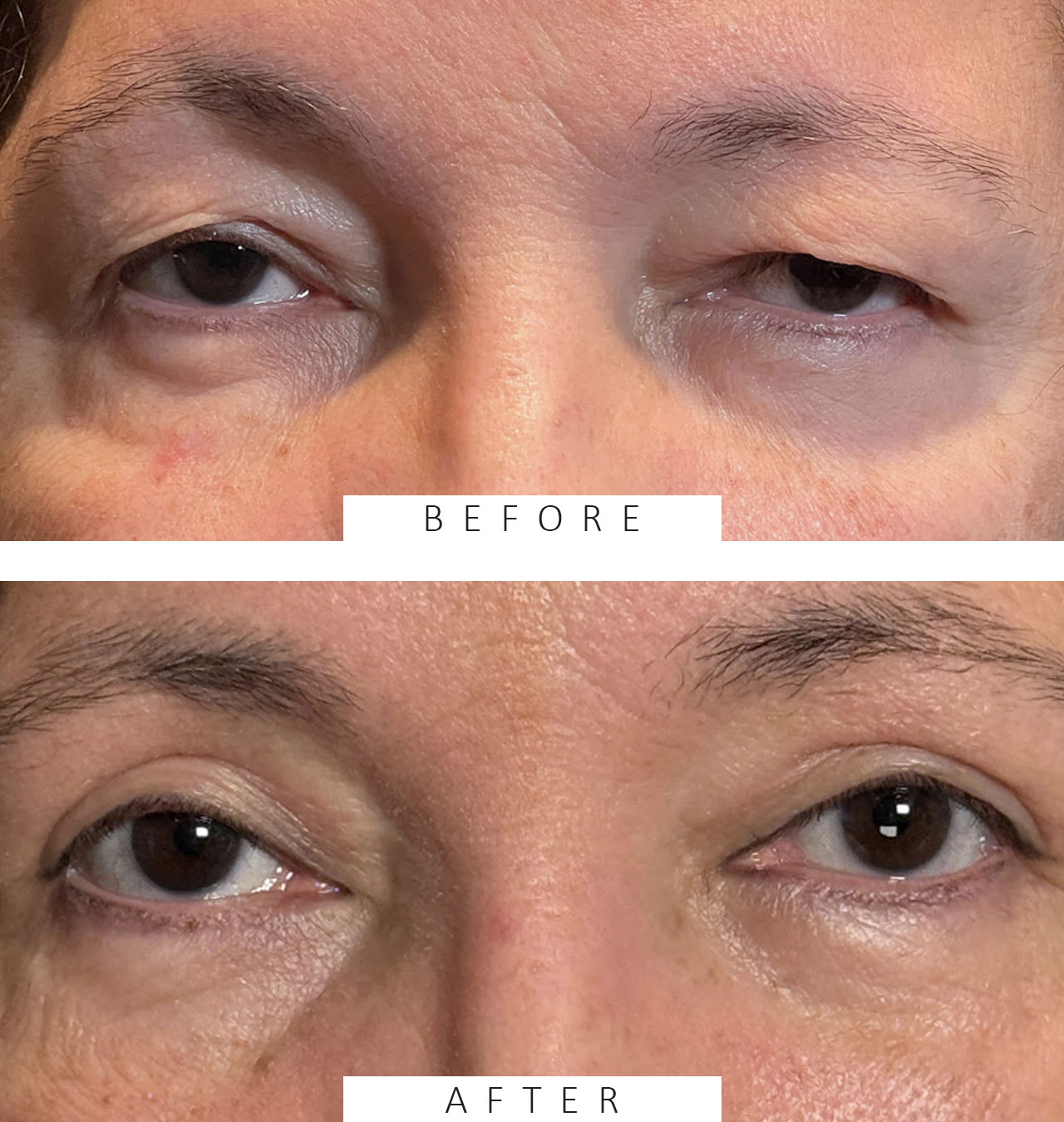 Cosmetic Blepharoplasty Both Upper Lids
