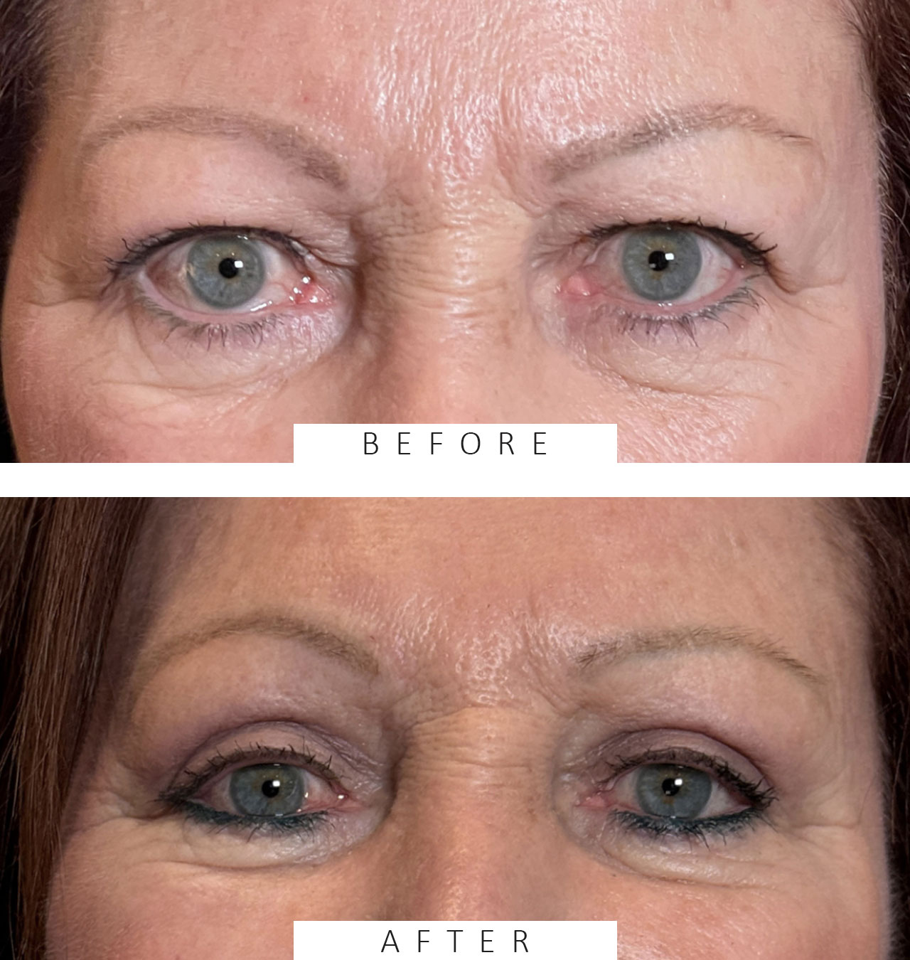 Cosmetic Blepharoplasty